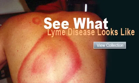 See What Lyme Disease Looks Like