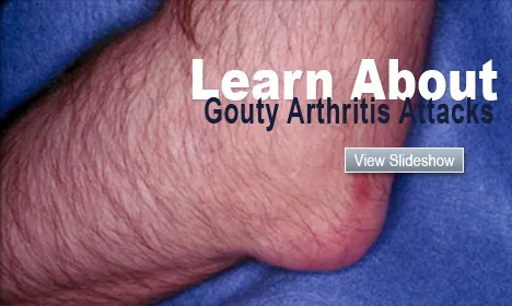 Learn About Gouty Arthritis Attacks