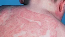 Eczema