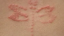 Contact Dermatitis