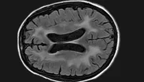 HIV Dementia