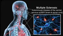 Multiple Sclerosis