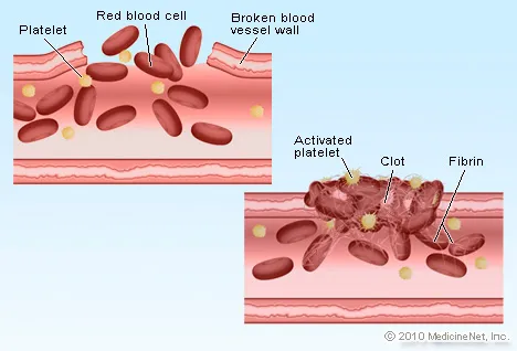 Picture of Blood Clot