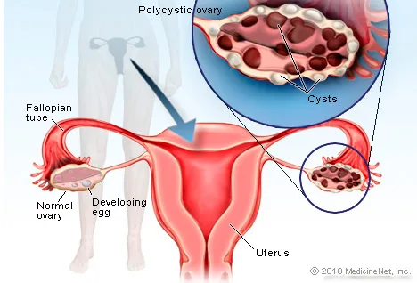 Illustration of Polycystic Ovary Syndrome