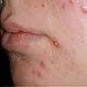 Picture of Acne