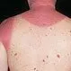 Picture of Acute Sunburn