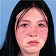 Picture of Acute Systemic Lupus