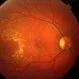 Picture of Age-Related Macular Degeneration