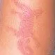 Picture of Allergic Contact Dermatitis (Arm)