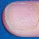 Picture of Alopecia Areata (Nails)