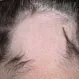 Picture of Alopecia Areata