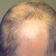 Picture of Alopecia Areata