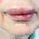 How Is Angioedema Treated?