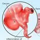 Picture of Appendicitis