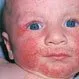 Picture of Atopic Dermatitis