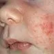 Picture of Baby Acne