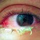 Picture of Bacterial Conjunctivitis (Pink Eye)