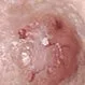 Picture of Basal Cell Carcinoma (Advanced Nodular BCC)