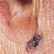 Picture of Basal Cell Carcinoma (Ear)