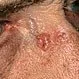 Picture of Basal Cell Carcinoma (Nose)