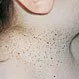 Picture of Basal Cell Nevus Syndrome