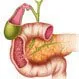 Bile Duct Cancer (Cholangiocarcinoma)