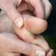 Picture of Blisters