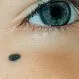 Picture of Blue Nevus