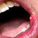 Canker Sores