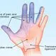 Picture of Carpal Tunnel Syndrome