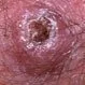 Picture of Squamous Cell Carcinoma with Central Hyperkeratosis