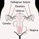 Cervical Dysplasia