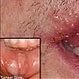 Picture of Cold Sore and Canker Sore