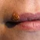 Picture of Cold Sores Treatment