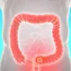 How Do Bowel Movements Change With Colon Cancer?