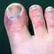 What Are COVID Toes and Fingers?