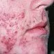 Picture of Cystic Acne