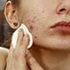 Cystic Acne