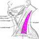 Cystic Hygroma