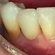 Picture of Dental Implant