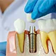 Are Dental Implants Worth It?