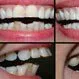 Picture of Dental Makeover