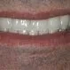 Picture of Dental Veneers