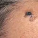 Picture of Desmoplastic Melanoma