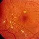 Picture of Diabetic Retinopathy