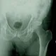 What Are the Symptoms of Hip Dysplasia?