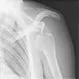 Dislocated Shoulder