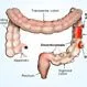 Picture of Diverticulosis