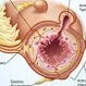 Duodenal Diverticulum