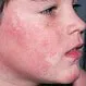 Picture of Erythema Infectiosum